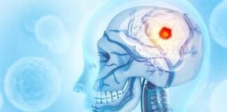 Гліобластома: несподіваний зв’язок між раком мозку та руйнуванням кісток черепа