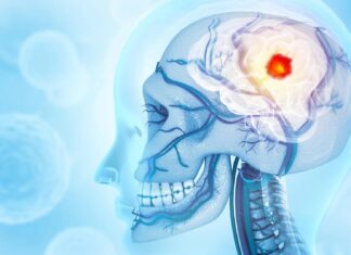 Гліобластома: несподіваний зв’язок між раком мозку та руйнуванням кісток черепа