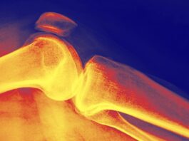 Игра вдолгую: как понять плотность костей и защитить их