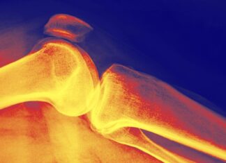 Игра вдолгую: как понять плотность костей и защитить их