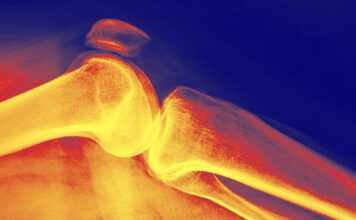 Игра вдолгую: как понять плотность костей и защитить их